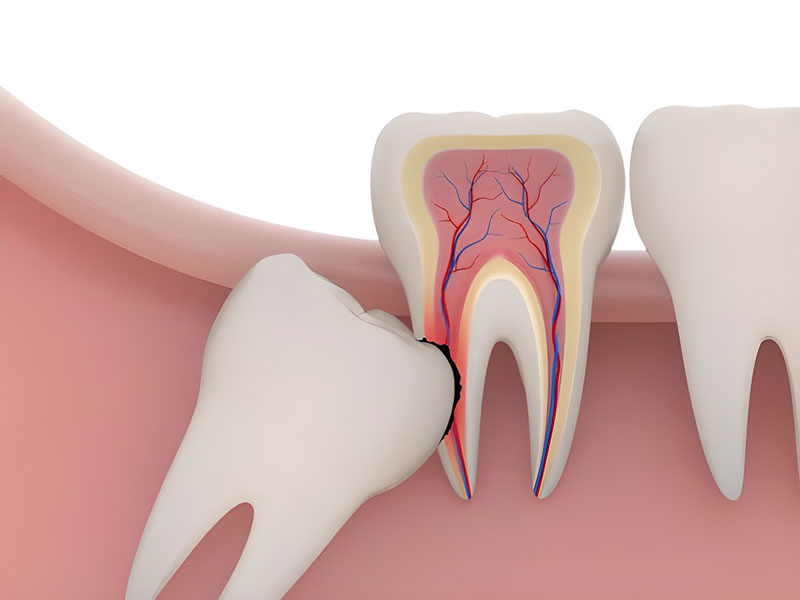 Nhổ răng khôn có nguy hiểm không? Những điều cần lưu ý