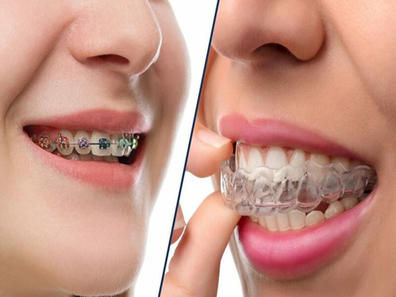 Niềng răng trong suốt lâu hay mau hơn niềng mắc cài?