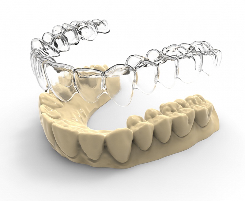 Niềng răng eCligner cũng là những lựa chọn bạn nên cân nhắc