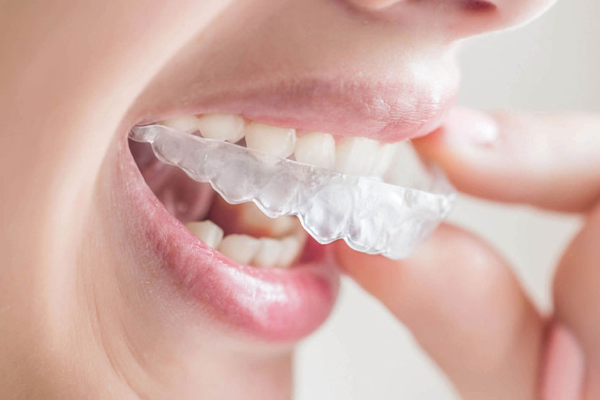 Phương pháp niềng răng 3D Clear Aligner được sản xuất theo công nghệ Đức