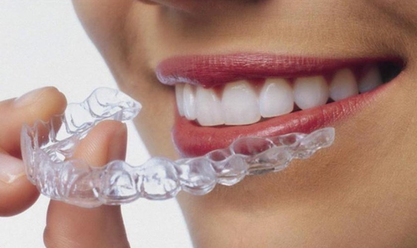 Niềng răng vô hình không mắc cài bao nhiêu tiền, có đắt không?